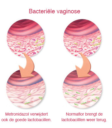 Bacteriële vaginose en stinkende afscheiding bestrijden met Normaflor
